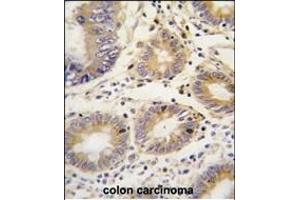 Formalin-fixed and paraffin-embedded human colon carcinoma tissue reacted with LEFTB antibody (C-term)  , which was peroxidase-conjugated to the secondary antibody, followed by DAB staining. (LEFTY1 抗体  (C-Term))