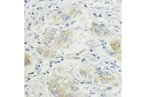 Immunohistochemistry of paraffin-embedded human liver cancer using SURF4 antibody (ABIN7270650) at dilution of 1:200 (40x lens). (Surfeit 4 抗体  (AA 50-150))