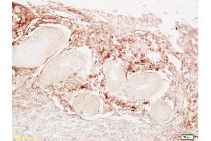 Formalin-fixed and paraffin embedded human lung carcinoma labeled with Anti-LDL Polyclonal Antibody, Unconjugated (ABIN678548) at 1:200, followed by conjugation to the secondary antibody and DAB staining (LDL 抗体)