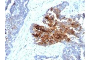 IHC staining of human ovarian carcinoma with TAG-72 antibody cocktail (B72. (TAG-72 抗体)