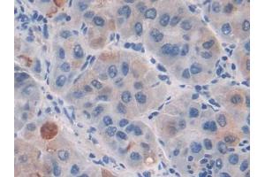 IHC-P analysis of Human Liver cancer Tissue, with DAB staining. (CILP 抗体  (AA 603-846))