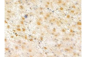 ABIN6264705 and ABIN6266630 at 1/100 staining human astrocytoma by IHC-P. (Retinoic Acid Receptor beta 抗体  (Internal Region))