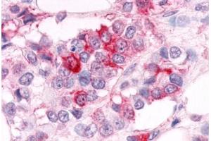 Anti-ESRRA antibody  ABIN1048581 IHC staining of human breast carcinoma. (ESRRA 抗体  (Ligand Binding Domain))