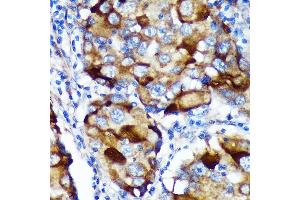 Immunohistochemistry of paraffin-embedded Human breast cancer using  Rabbit pAb (ABIN7265743) at dilution of 1:100 (40x lens). (ABCF3 抗体  (AA 1-200))