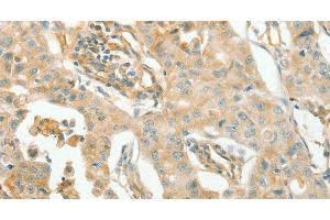 Immunohistochemistry of paraffin-embedded Human lung cancer using ACE1 Polyclonal Antibody at dilution of 1:70 (Angiotensin I Converting Enzyme 1 抗体)
