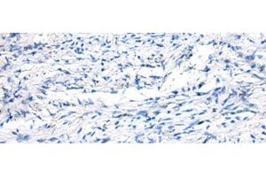 Immunohistochemistry of paraffin-embedded Human ovarian cancer tissue using FGF11 Polyclonal Antibody at dilution of 1:50(x200) (FGF11 抗体)