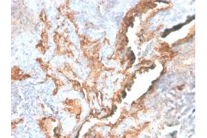 Formalin-fixed, paraffin-embedded human Lung Carcinoma stained with Tenascin C Rabbit Recombinant Monoclonal Antibody (TNC/2981R). (Recombinant TNC 抗体)