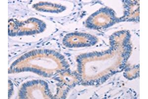 The image on the left is immunohistochemistry of paraffin-embedded Human colon cancer tissue using ABIN7131322(TEKT4 Antibody) at dilution 1/20, on the right is treated with fusion protein. (Tektin 4 抗体)