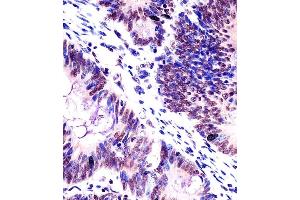 (ABIN6242416 and ABIN6578503) staining KHDRBS1 in human colorectal carcinoma tissue sections by Immunohistochemistry (IHC-P - paraformaldehyde-fixed, paraffin-embedded sections). (KHDRBS1 抗体  (AA 259-291))