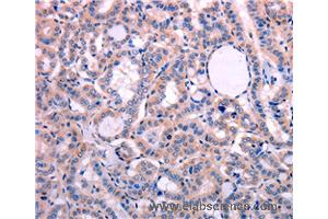Immunohistochemistry of Human thyroid cancer using LEP Polyclonal Antibody at dilution of 1:30 (Leptin 抗体)