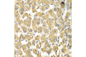 Immunohistochemistry of paraffin-embedded human liver injury using MAP4K3 antibody at dilution of 1:100 (x400 lens). (MAP4K3 抗体)