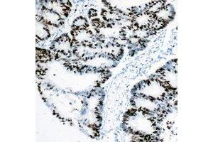 Immunohistochemical analysis of Rpb1 CTD staining in human colon cancer formalin fixed paraffin embedded tissue section. (Rpb1 CTD 抗体  (C-Term))