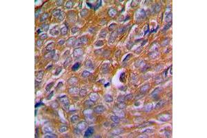 Immunohistochemical analysis of Calnexin (pS583) staining in human breast cancer formalin fixed paraffin embedded tissue section.