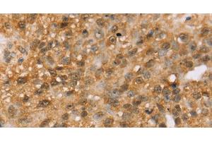 Immunohistochemistry of paraffin-embedded Human breast cancer tissue using MED22 Polyclonal Antibody at dilution 1:50 (MED22 抗体)