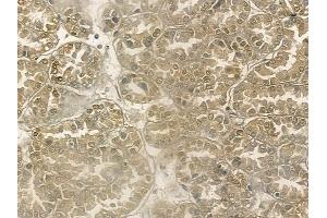 ABIN6266124 and ABIN6272493 at 1/100 staining human renal cell carcinoma by IHC-P. (ZNF295 抗体  (N-Term))