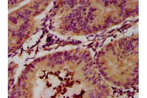 IHC image of ABIN7151818 diluted at 1:300 and staining in paraffin-embedded human endometrial cancer performed on a Leica BondTM system. (EPX 抗体  (AA 140-300))