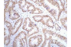 IHC-P staining of Human colon cancer tissue paraffin-embedded, diluted at 1:200.