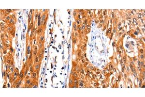 Immunohistochemistry of paraffin-embedded Human esophagus cancer tissue using FBLN1 Polyclonal Antibody at dilution 1:47 (Fibulin 1 抗体)