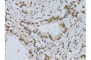 Immunohistochemistry of paraffin-embedded human gastric cancer using EMD antibody (ABIN6290347) at dilution of 1:100 (40x lens). (Emerin 抗体)