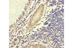 Immunohistochemistry of paraffin-embedded human colon cancer using ABIN7155943 at dilution of 1:100 (Chromosome X Open Reading Frame 27 (CXORF27) (AA 1-117) 抗体)