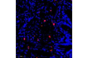 Immunofluorescence of paraffin embedded human lung cancer using CST9L (ABIN7073650) at dilution of 1:900 (300x lens)