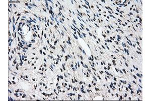 Immunohistochemical staining of paraffin-embedded Adenocarcinoma of breast tissue using anti-PSMD10 mouse monoclonal antibody. (PSMD10 抗体)