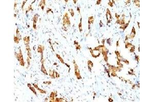 Formalin-fixed, paraffin-embedded human breast carcinoma stained with HSP27 antibody (SPM252) (HSP27 抗体)