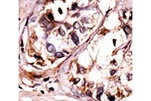 IHC analysis of FFPE human hepatocarcinoma tissue stained with the phospho-Syk antibody. (SYK 抗体  (pTyr525, pTyr526))