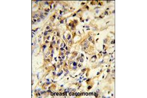 Formalin-fixed and paraffin-embedded human breast carcinoma reacted with RPGRIP1 Antibody , which was peroxidase-conjugated to the secondary antibody, followed by DAB staining. (RPGRIP1 抗体  (AA 530-557))