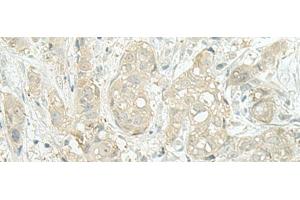 Immunohistochemistry of paraffin-embedded Human breast cancer tissue using MIEN1 Polyclonal Antibody at dilution of 1:45(x200) (C17orf37 抗体)