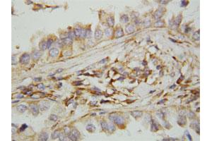 Immunohistochemical staining of paraffin-embedded human lung cancer tissue section with CXCL9 polyclonal antibody . (CXCL9 抗体  (N-Term))