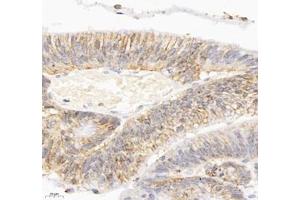 Immunohistochemistry of paraffin embedded human colon cancer using ATP1A1 (ABIN7073154) at dilution of 1: 500 (400x lens) (ATPase (Na/K) 抗体)