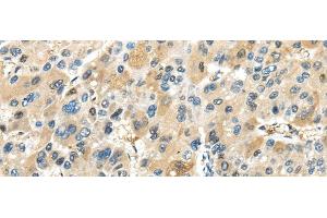 Immunohistochemistry of paraffin-embedded Human liver cancer tissue using TRAIP Polyclonal Antibody at dilution 1:40 (TRAIP 抗体)