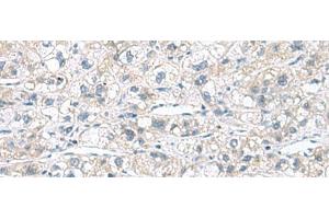 Immunohistochemistry of paraffin-embedded Human liver cancer tissue using CACNB1 Polyclonal Antibody at dilution of 1:110(x200) (CACNB1 抗体)