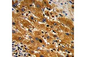 IHC analysis of FFPE human hepatocarcinoma with Caspase-9 antibody (Caspase 9 抗体  (Ser196))