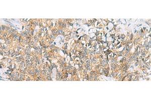 Immunohistochemistry of paraffin-embedded Human ovarian cancer tissue using TUFT1 Polyclonal Antibody at dilution of 1:120(x200) (TUFT1 抗体)