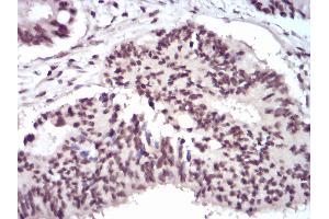 Immunohistochemical analysis of paraffin-embedded rectum cancer tissues using WTAP mouse mAb with DAB staining. (WTAP 抗体  (AA 91-201))