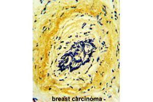 Formalin-fixed and paraffin-embedded human breast carcinomareacted with HTRA1 polyclonal antibody , which was peroxidase-conjugated to the secondary antibody, followed by AEC staining.