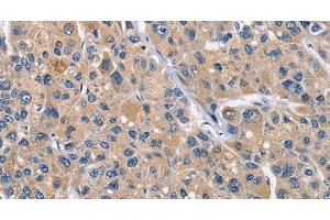 Immunohistochemistry of paraffin-embedded Human liver cancer tissue using CLEC2D Polyclonal Antibody at dilution 1:70 (CLEC2D 抗体)