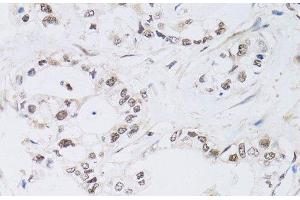 Immunohistochemistry of paraffin-embedded Human gastric cancer using PAX3 Polyclonal Antibody at dilution of 1:100 (40x lens). (Paired Box 3 抗体)