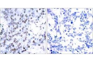 Immunohistochemistry analysis of paraffin-embedded human breast carcinoma tissue, using JunB (Ab-79) Antibody. (JunB 抗体  (AA 46-95))