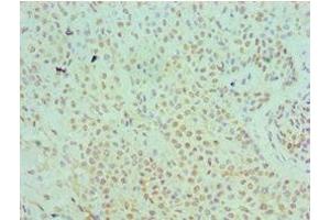 Immunohistochemistry of paraffin-embedded human breast cancer using ABIN7169345 at dilution of 1:100 (SERPINB5 抗体  (AA 21-189))