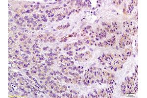 Formalin-fixed and paraffin embedded human endometrial carcinoma labeled with Anti-Notch1/MOTC Polyclonal Antibody, Unconjugated  at 1:200 followed by conjugation to the secondary antibody and DAB staining (Notch1 抗体  (AA 2101-2300))