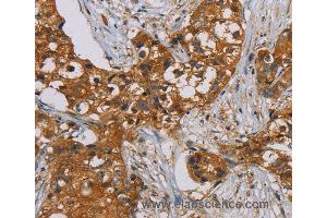 Immunohistochemistry of Human breast cancer using PSMC2 Polyclonal Antibody at dilution of 1:25 (PSMC2 抗体)