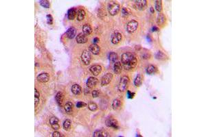 Immunohistochemical analysis of MKK4 (pT261) staining in human breast cancer formalin fixed paraffin embedded tissue section. (MAP2K4 抗体  (pSer261))