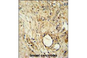 ITIH5 Antibody immunohistochemistry analysis in formalin fixed and paraffin embedded human breast carcinoma followed by peroxidase conjugation of the secondary antibody and DAB staining. (ITIH5 抗体  (C-Term))