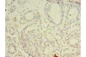 Immunohistochemistry of paraffin-embedded human breast cancer using ABIN7147697 at dilution of 1:100 (CBX2 抗体  (AA 1-211))