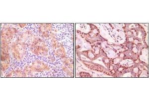 Immunohistochemical analysis of paraffin-embedded human ovary carcinoma (left) and breast carcinoma (right), showing cytoplasmic(ovary carcinoma) localization, cytoplasmic and nuclear (breast carcinoma) localization using SNCG antibody with DAB staining.