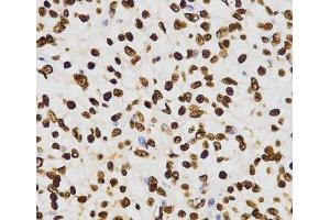 Immunohistochemistry of paraffin-embedded Human kidney cancer using DiMethyl-Histone H3-K27 Polyclonal Antibody at dilution of 1:200 (40x lens). (Histone 3 抗体  (2meLys27))