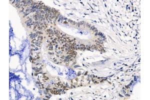 ABIN6263350 and ABIN6268864 at 1/100 staining Human colorectal cancer by IHC-P. (Mre11 抗体  (Internal Region))